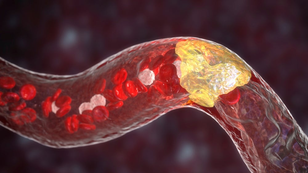 Ionis reports success in olezarsen trial for high triglycerides