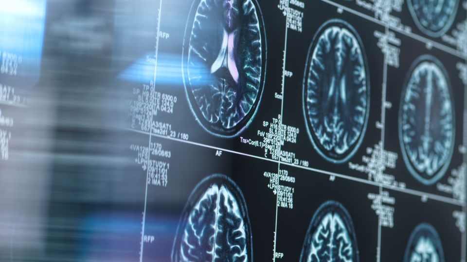 Scientists say it may be possible to protect aging brains from Alzheimer's with an old remedy — lithium