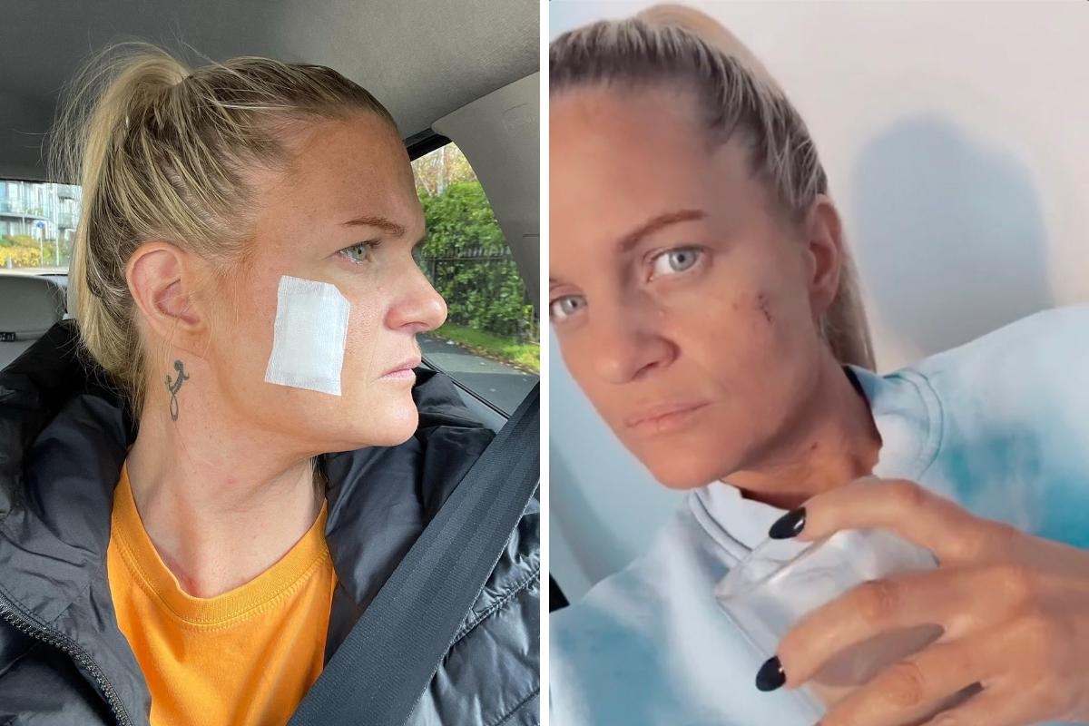 Ex-tanning addict warns Gen Z of sunbed dangers after getting skin cancer twice