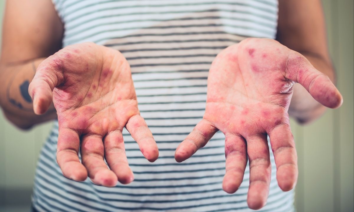 First Measles Case Recorded In Dallas County