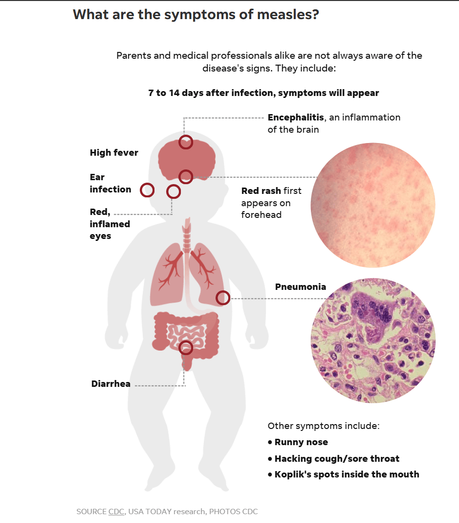 Montcalm County has Michigan's first measles outbreak of 2025