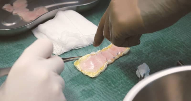 New stem cell patch promises to cure severe heart problems