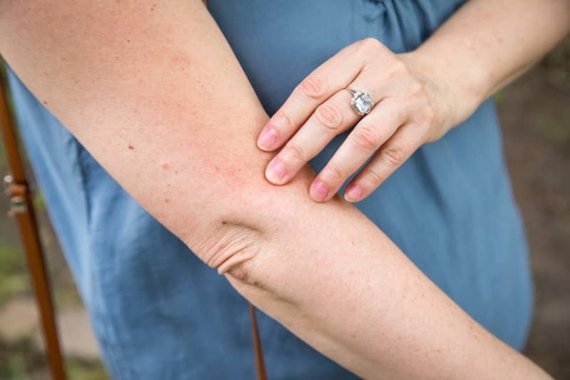New AI tool could speed up skin cancer diagnoses in remote areas
