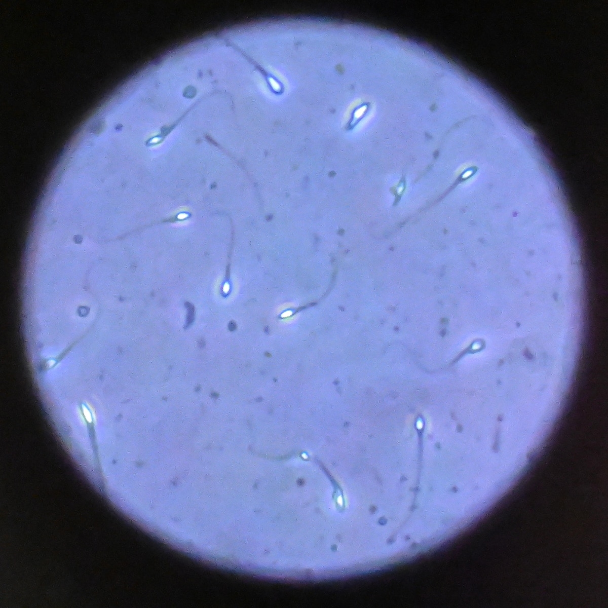 Sperm Donor With Rare Mutation Linked to Cancer Sparks Debate