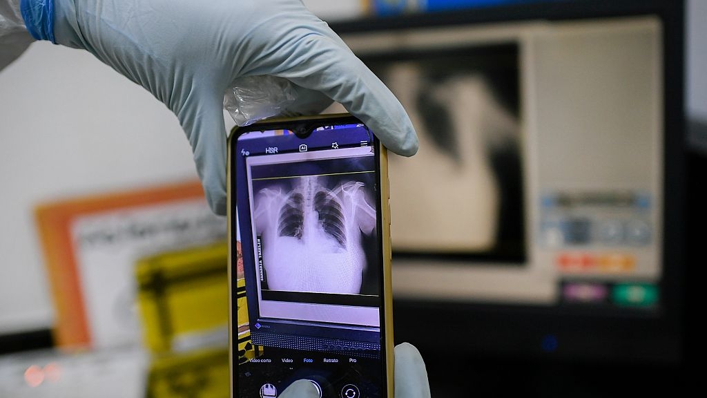 Tuberculosis cases are up among kids in Europe and Central Asia, health authorities warn