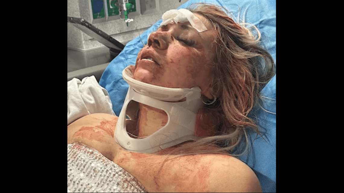 Bride-to-be says stranger knocked her unconscious near Dallas bar after bachelorette party