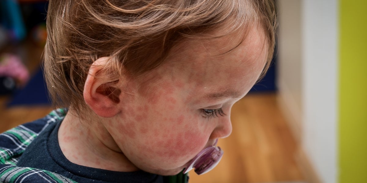 Measles Or A Cold? How To Tell Them Apart As Cases Expected To Rise