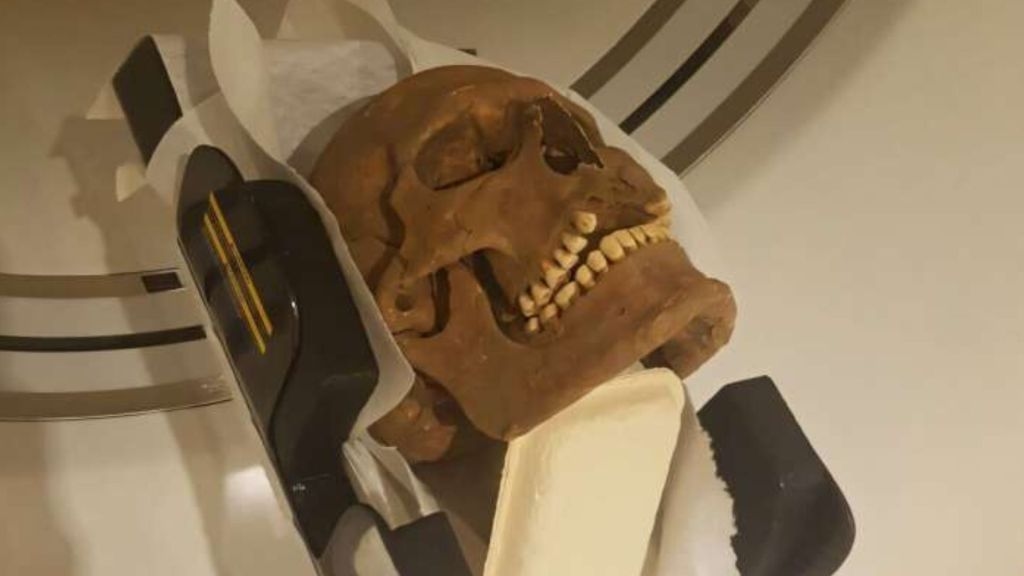 Mighty Vikings battled severe diseases, reveals 10th-century skulls' study