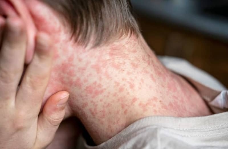 At least 62 Israelis infected with measles amid outbreak, Health Ministry says