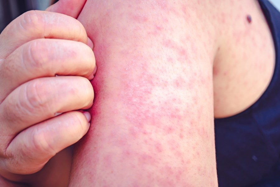Measles case confirmed in vaccinated Coloradan who flew into DIA
