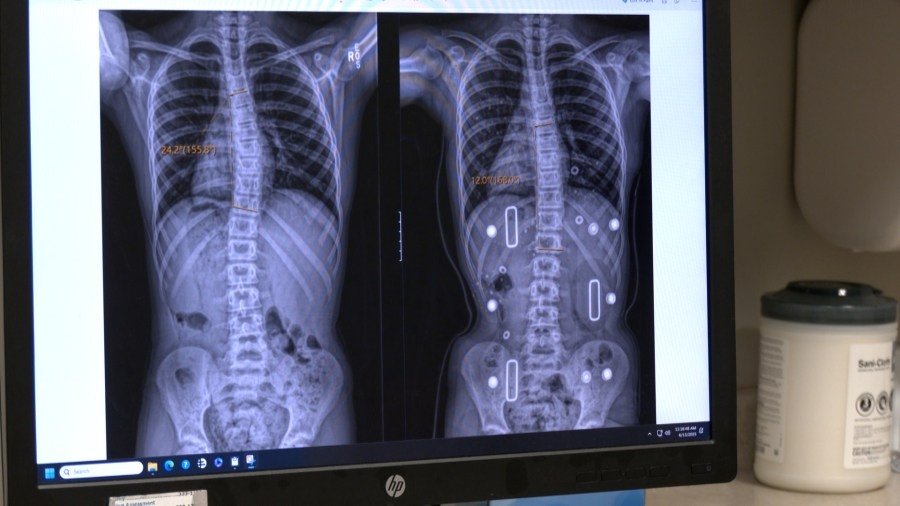 Family shares experience with scoliosis: What to know