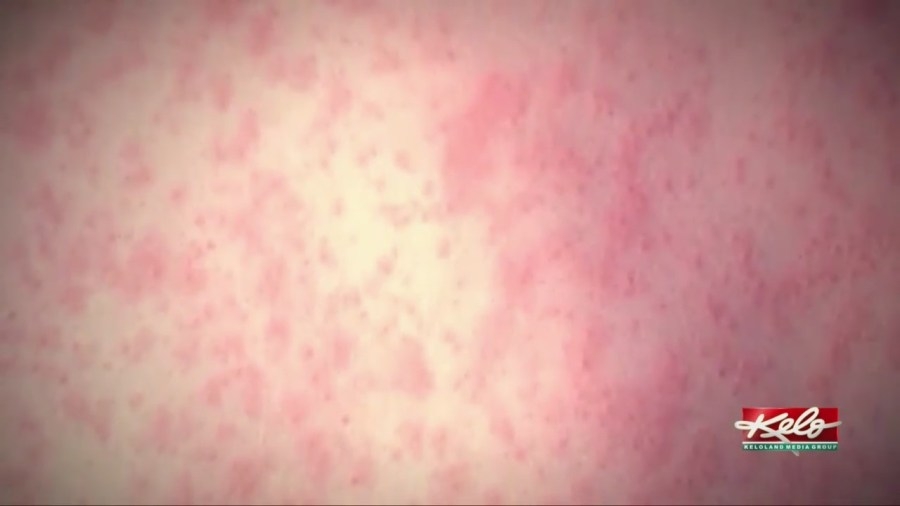 Fighting against the spread of Measles