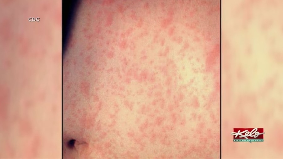 What a Doctor wants you to know about Measles