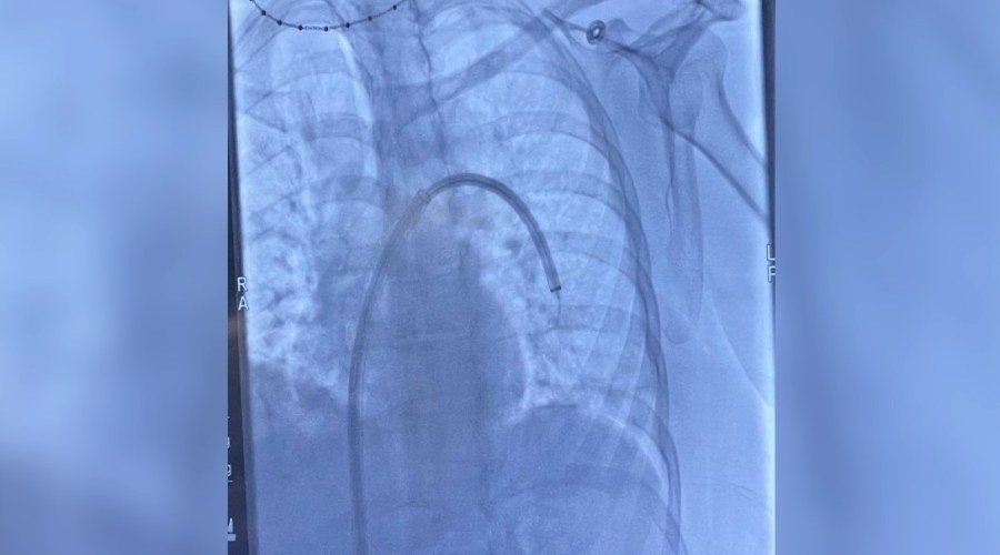 Woman shares blood clot diagnosis, recovery journey