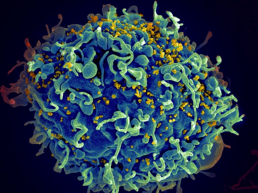 Kern County HIV cases at an all-time high, public health director says, and federal funding cuts could make it worse quickly