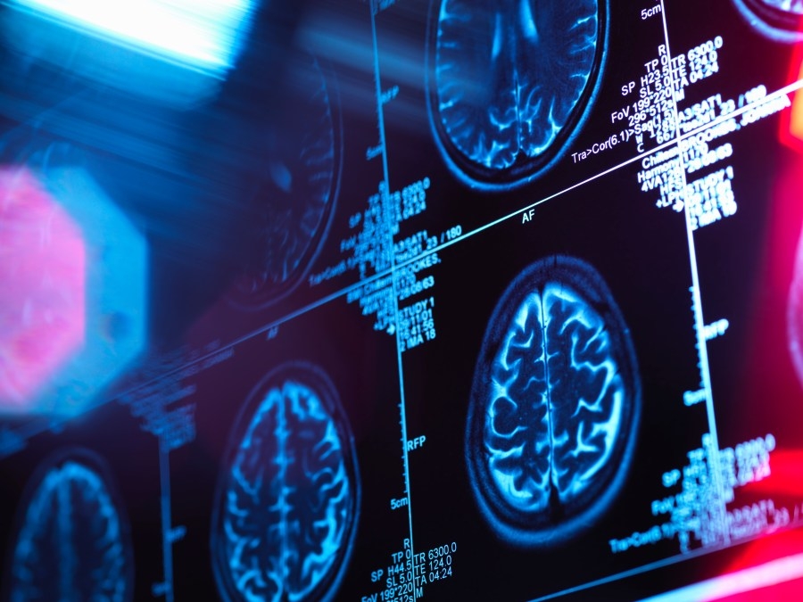 3 cases of rare brain disease reported in Hood River County; 2 reported dead