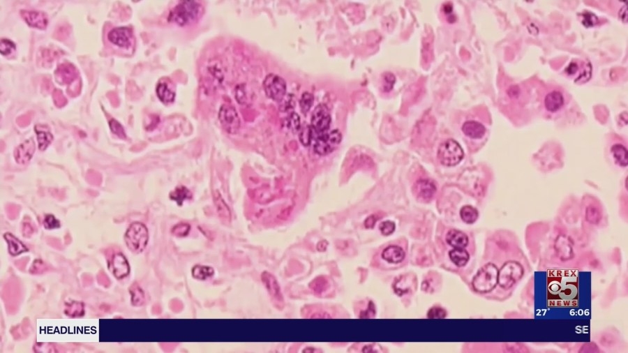First measles case found in Colorado