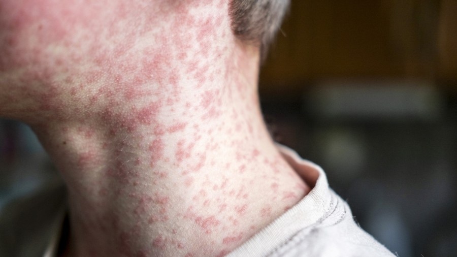 Kansas measles cases climb to 56, mostly in SW Kansas