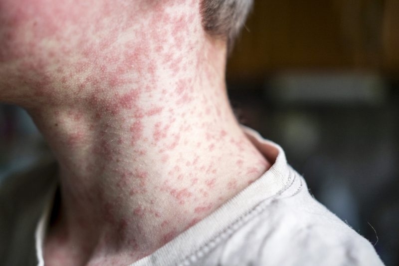 Six more measles cases in Kansas