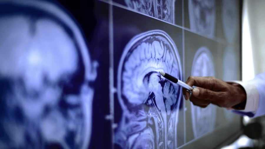 Via Christi: Brain imaging technology could extend stroke treatment window