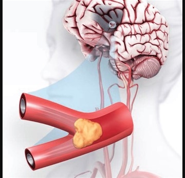Signs of Stroke: what to know for Stroke Awareness Month
