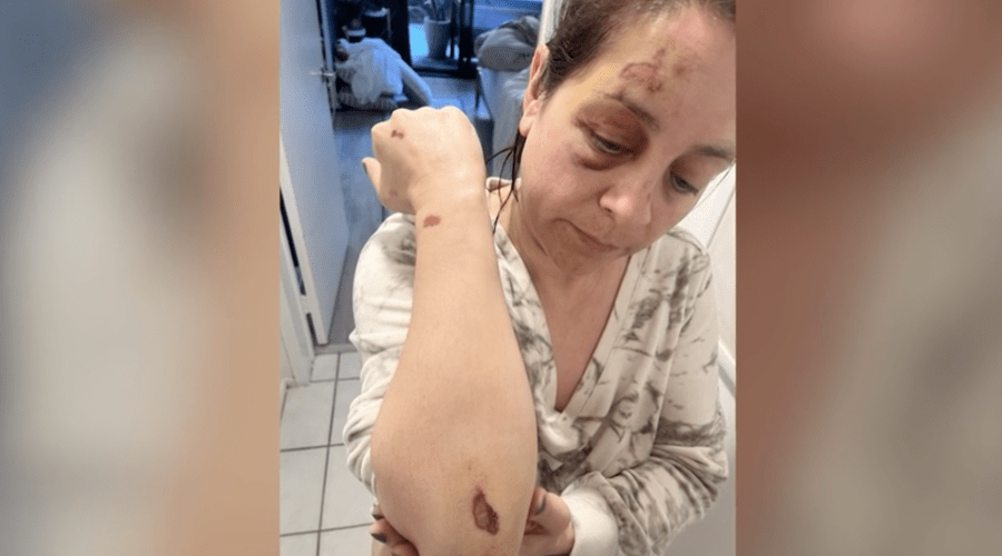 Survivor of brutal hit-and-run speaks out, asks for help finding L.A. driver