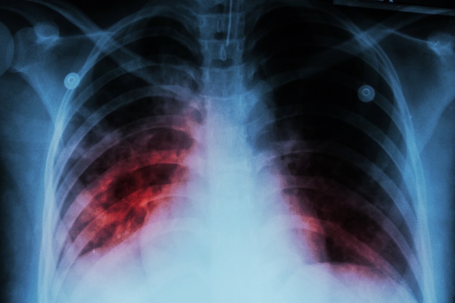 City of El Paso recognizes World Tuberculosis Day