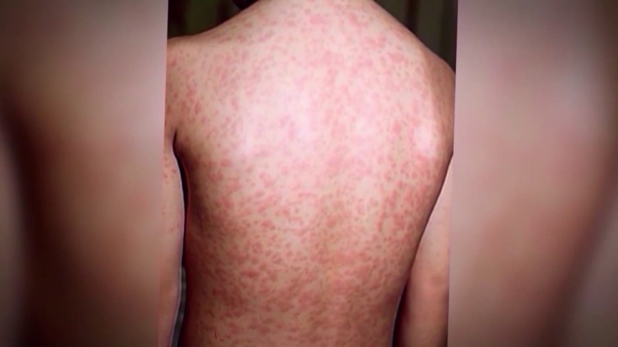 Measles case at St. Louis Aquarium triggers health alert