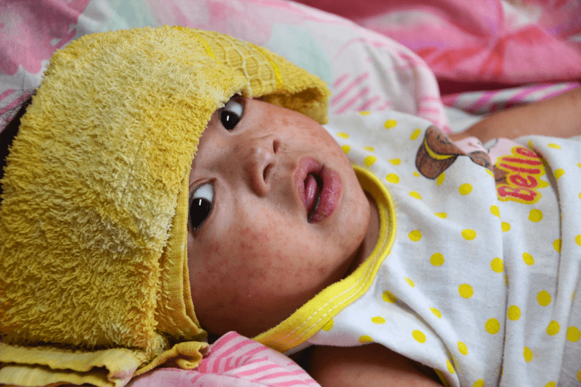 Immune amnesia: Why even mild measles infections can lead to serious disease later