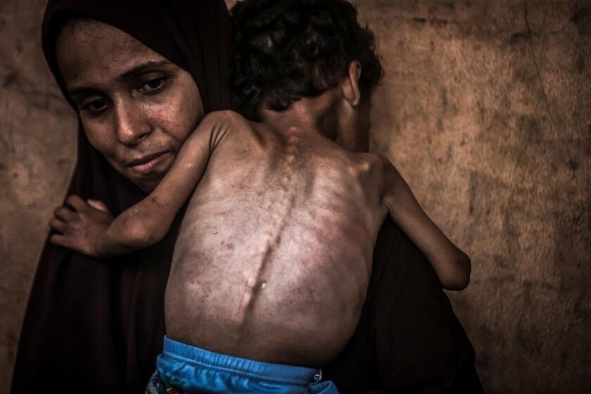 Famine's toll on the children of Gaza: The world shouldn't look away