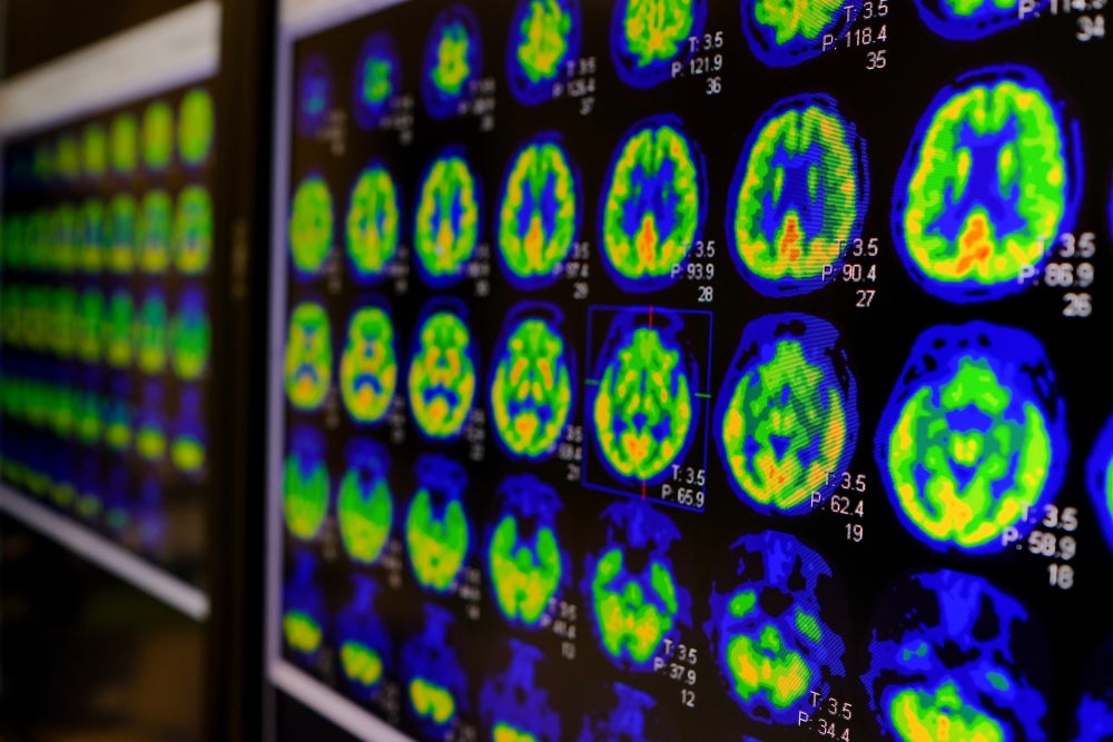 GE HealthCare's PET imaging agent gains Alzheimer's label expansion