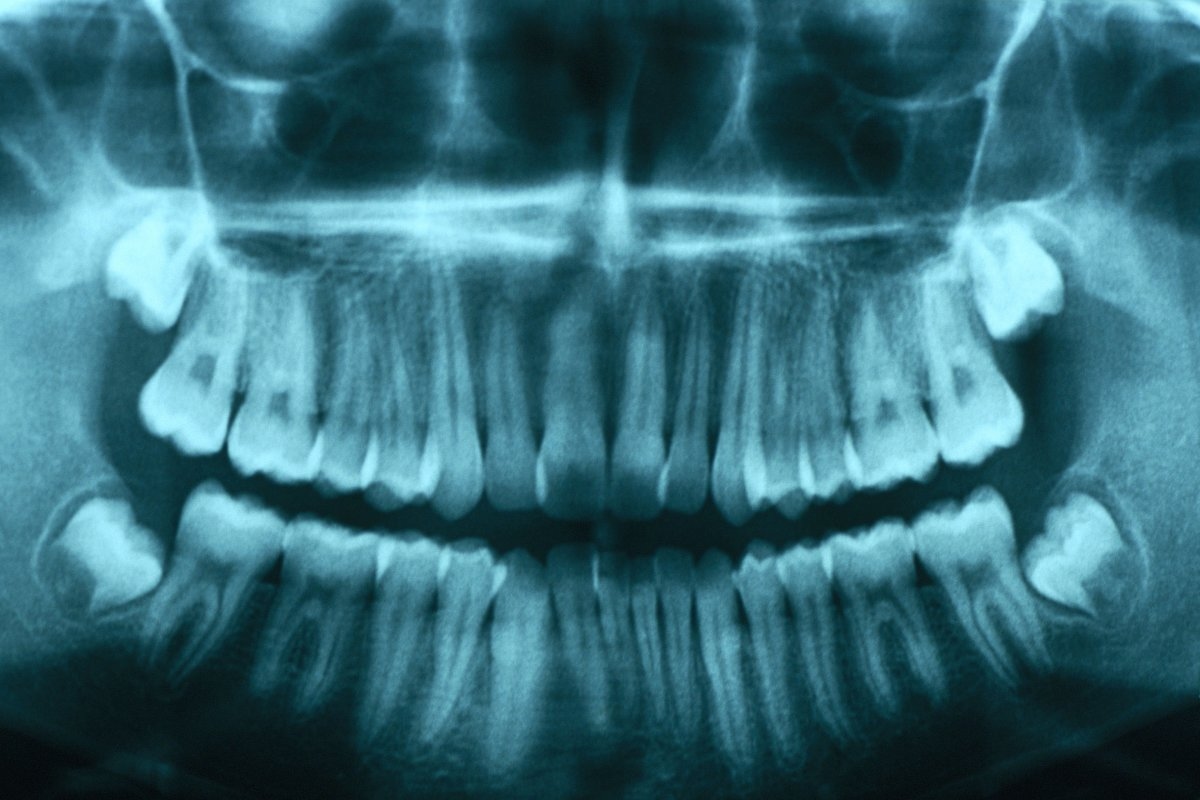 Missing A Tooth? Scientists Develop New Drug that Regrows Teeth