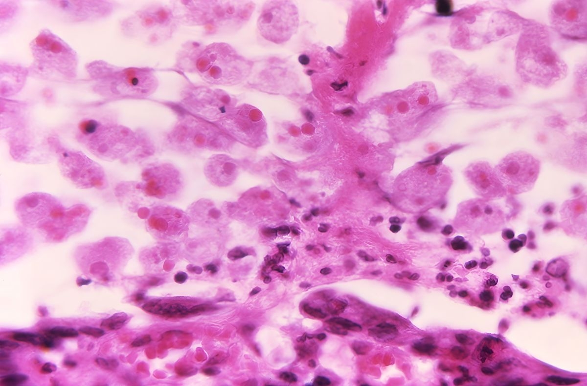 71-Year-Old Texas Woman Dies From Rare 'Brain-Eating Amoeba'