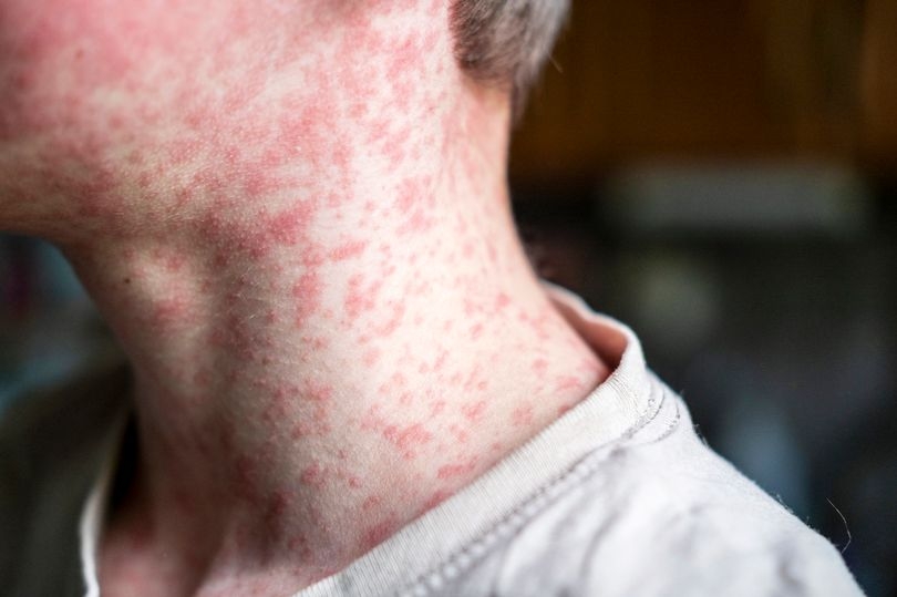 Pharmacist says 'stay home' as measles cases soar and spike is coming