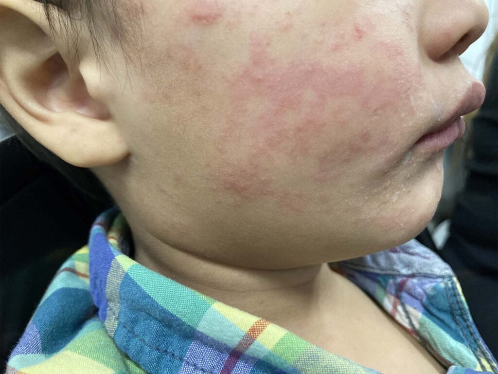 No measles reported yet in Nevada, but state's vaccination rate slipping