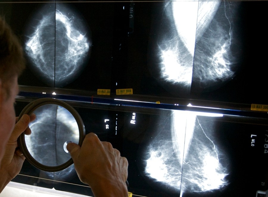 Breast cancer vaccine moving to critical phase