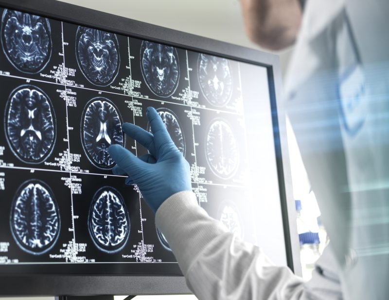 What are the 5 warning signs of a stroke?