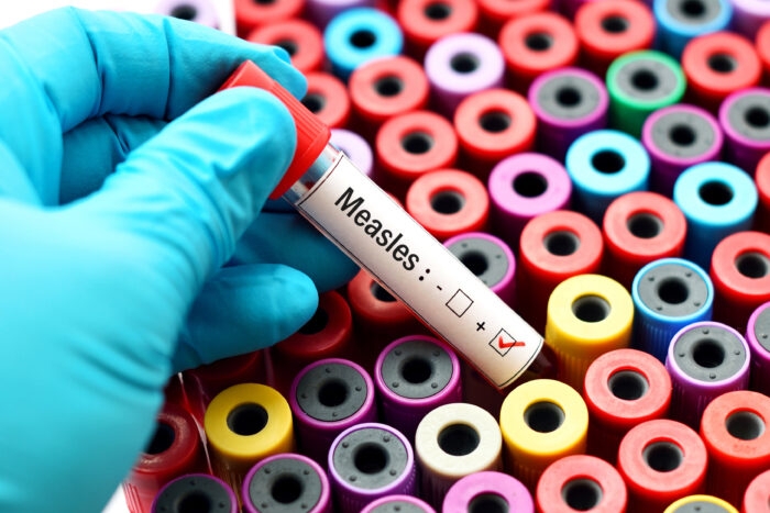 Confirmed measles cases in North Dakota rises to 19