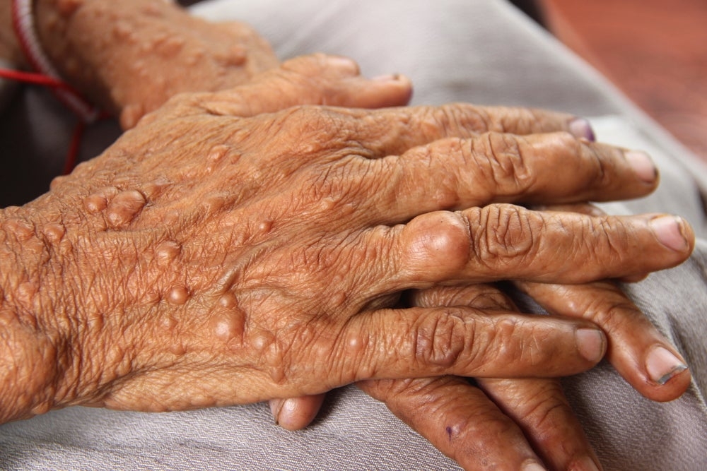 FDA approves Gomekli as first neurofibromatosis drug for adults