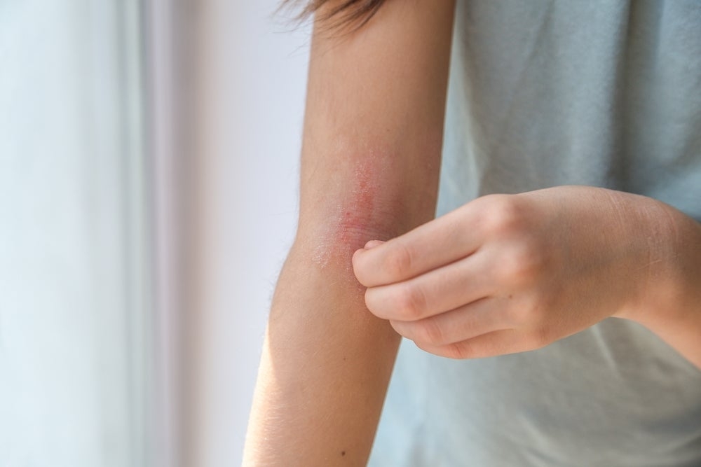 ‘Dupixent-fuelled' atopic dermatitis market sales to hit $22.4bn by 2033