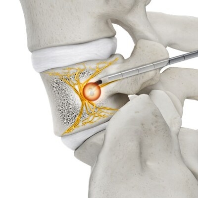 Stryker receives FDA clearance for OptaBlate® BVN Basivertebral Nerve Ablation System