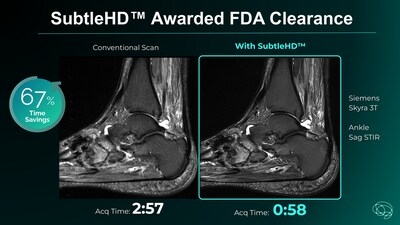 Subtle Medical's SubtleHD™ Awarded FDA Clearance, Setting a New Benchmark for MRI Image Quality and Speed