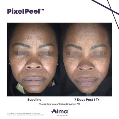 Alma Introduces PixelPeel™: A Smarter, Gentler Approach to Laser Skin Renewal