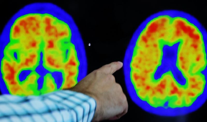 INmune Bio's Alzheimer's drug falls short of mid-stage study goal, shares tumble