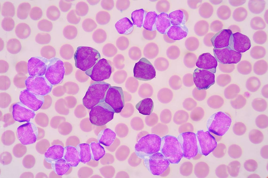 Sacramento doctor: If not for NIH funding, I wouldn't have survived my leukemia diagnosis