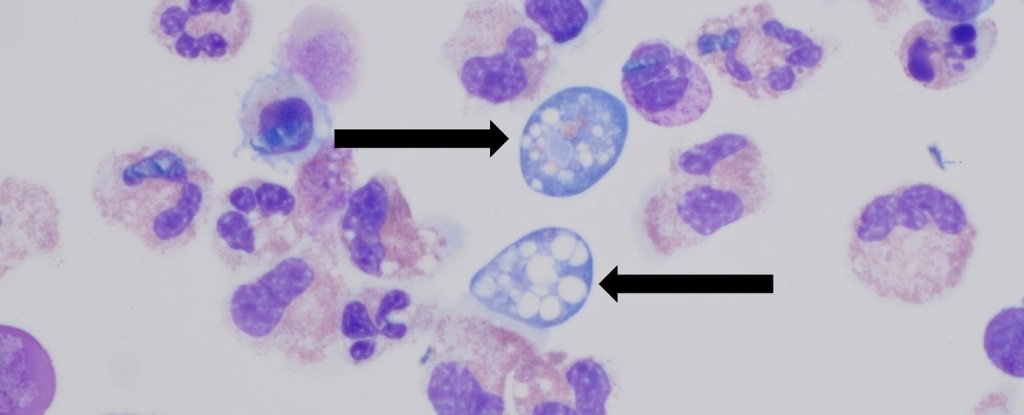 Texas Woman Dies From Brain-Eating Amoeba After Flushing Sinuses