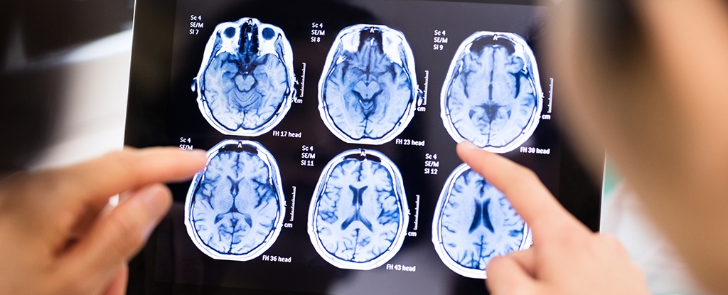 No, There Isn't a Mysterious Brain Disease Spreading in Canada