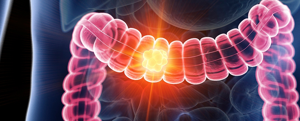 One Cancer Is Rising Rapidly in Younger People, And Bacteria Could Be Why