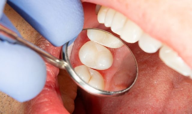 Buyout barons in battle to extract £800m dentistry giant