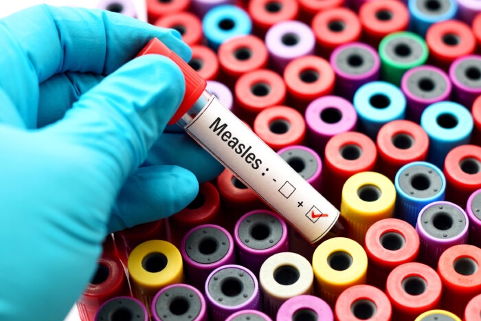 Stanford researcher: U.S. at a ‘tipping point on' measles resurgence